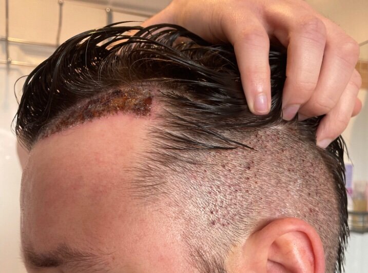 Dr Bisanga fue hair transplant3.jpeg