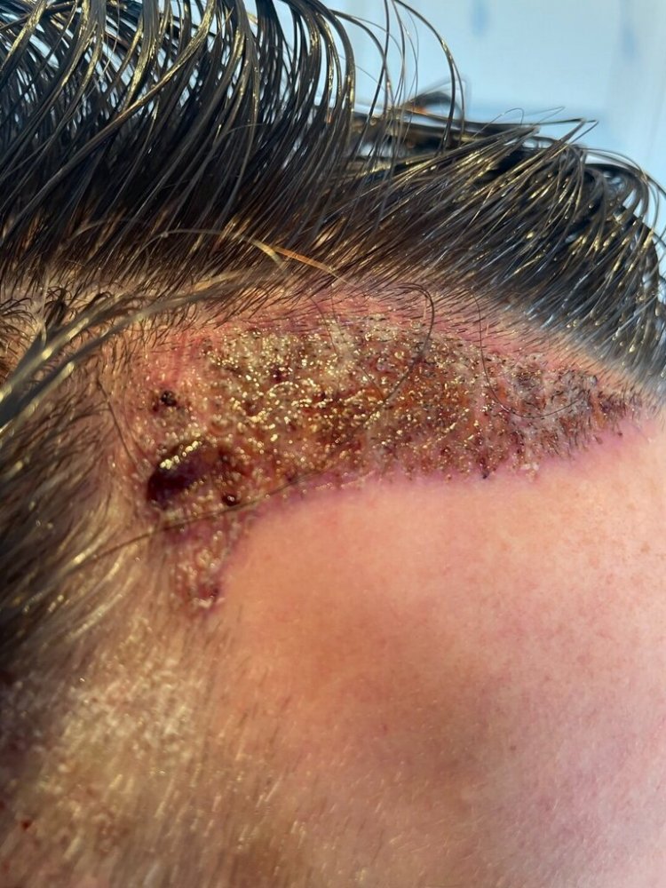 Dr Bisanga fue hair transplant5.jpeg