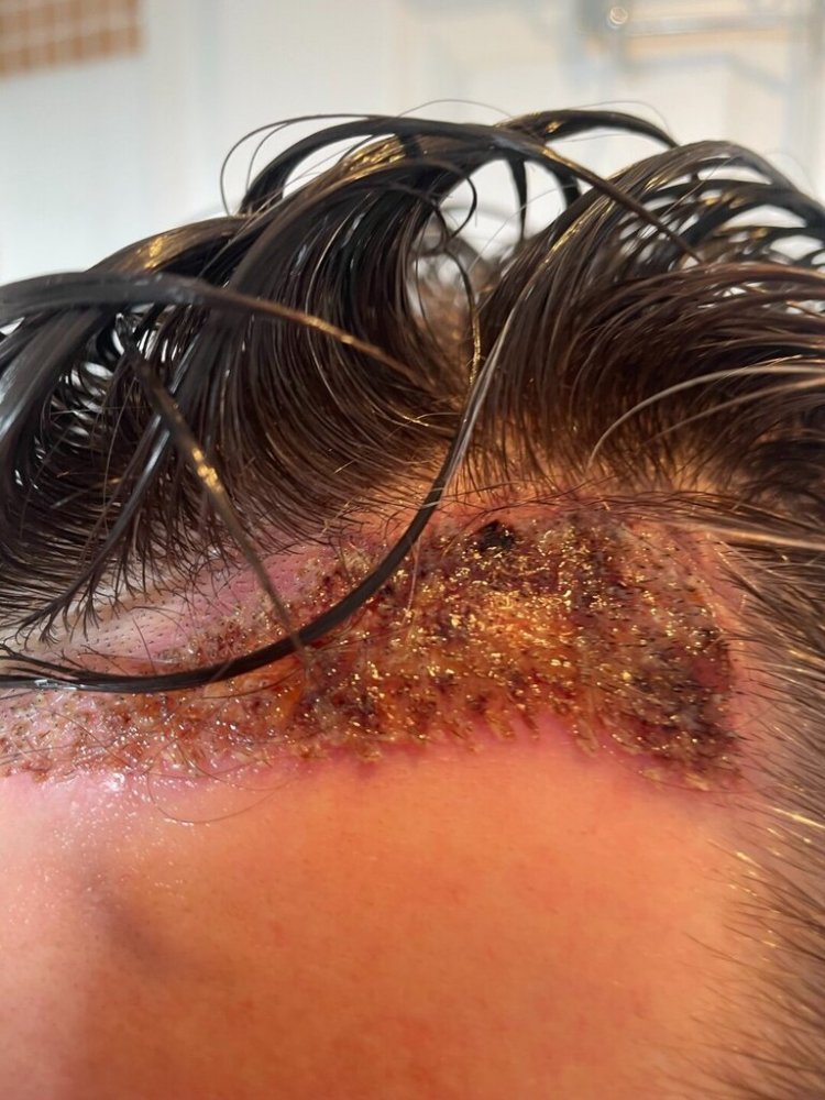 Dr Bisanga fue hair transplant6.jpeg