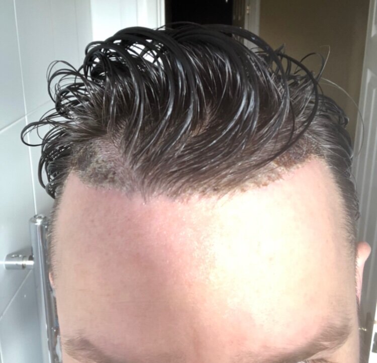 Dr Bisanga fue hair transplant7.jpeg