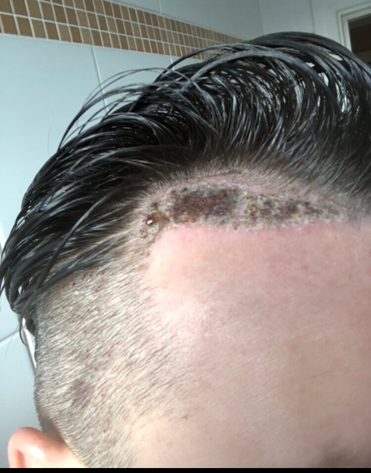 Dr Bisanga fue hair transplant9.jpeg