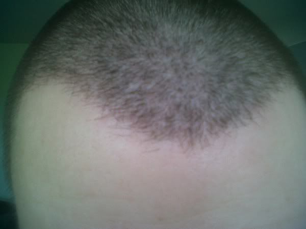 Dr. Bisanga hair transplant.jpg