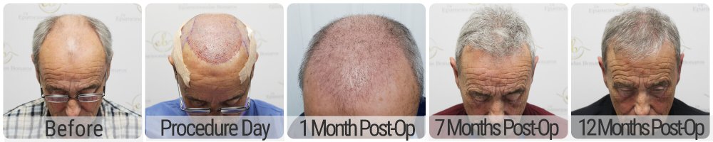 dr-bonaros-hair-transplant-glasgow (6) (6) (2).jpg