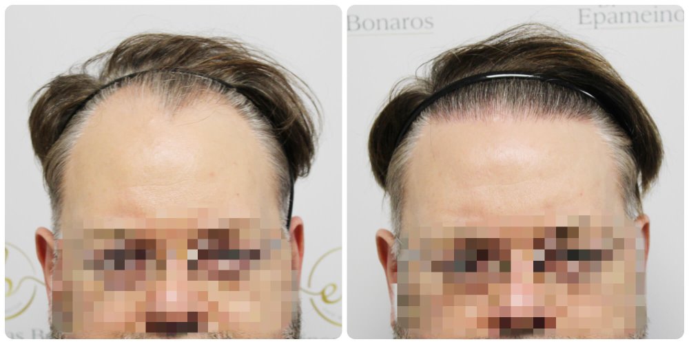 dr-bonaros-hair-transplant-glasgow-result (36) (1) (1).jpg