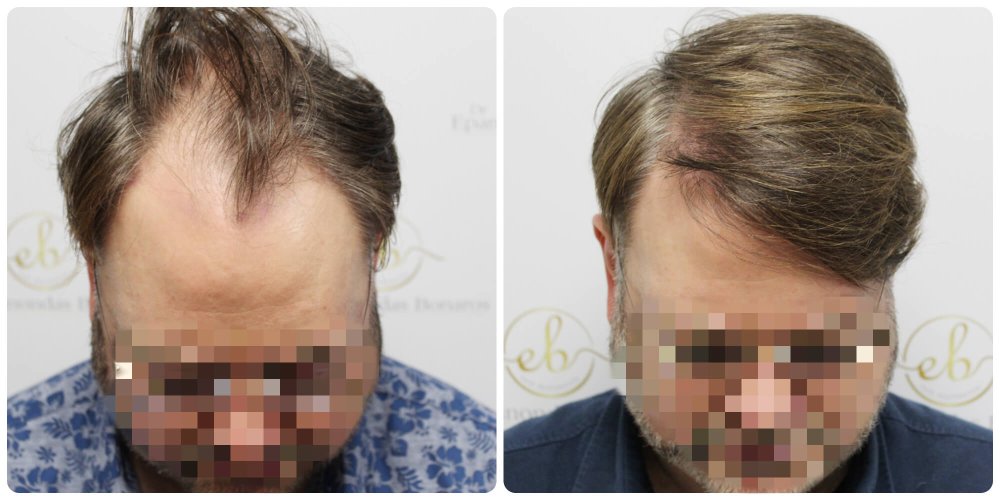 dr-bonaros-hair-transplant-glasgow-result (38) (2).jpg