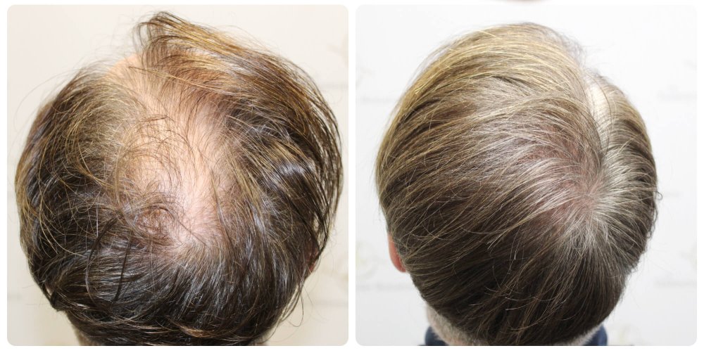 dr-bonaros-hair-transplant-glasgow-result (39) (2) (1).jpg