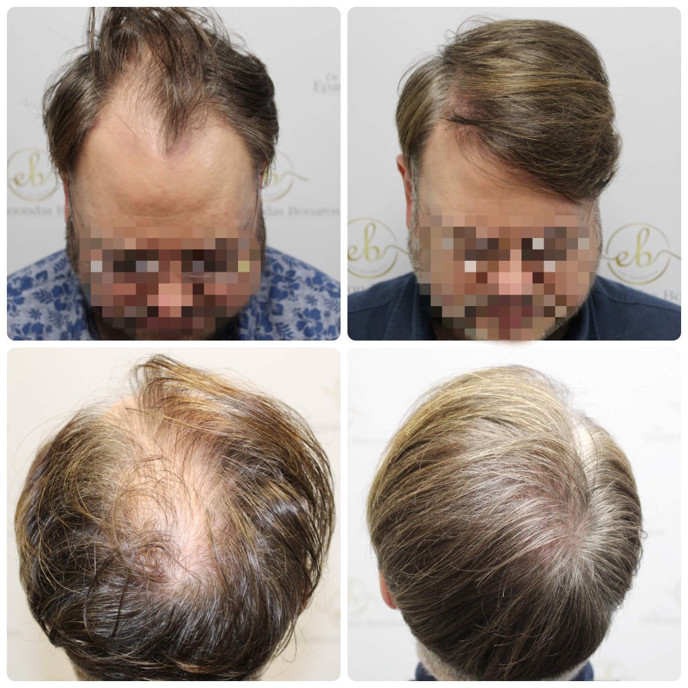 dr-bonaros-hair-transplant-glasgow-result (39) (2).jpg