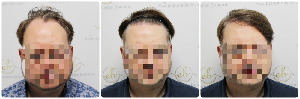 dr-bonaros-hair-transplant-glasgow-result (40) (1) (1).jpg