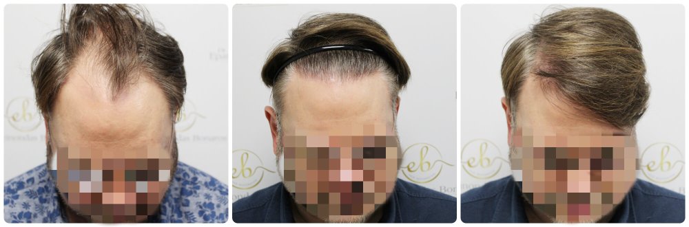 dr-bonaros-hair-transplant-glasgow-result (41) (2).jpg