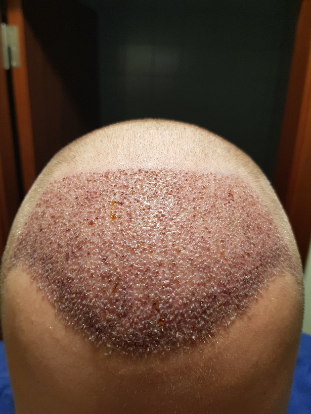 Dr. Bruno Ferreira - 3611 grafts - 28th & 29th of January 2020.jpg