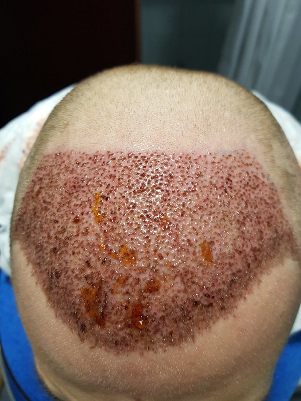 Dr. Bruno Ferreira FUE Hair Transplant.jpg