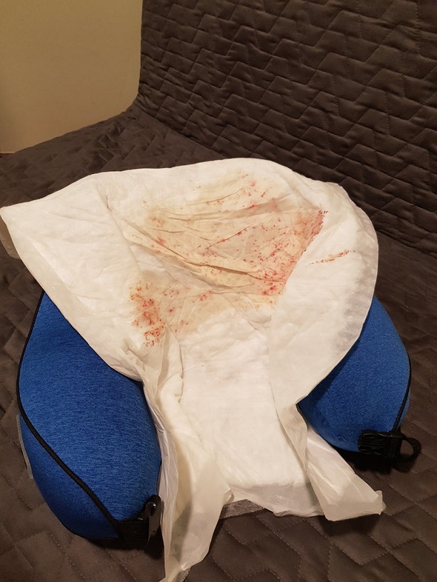 Dr. Bruno Ferreira hair transplant review.jpg