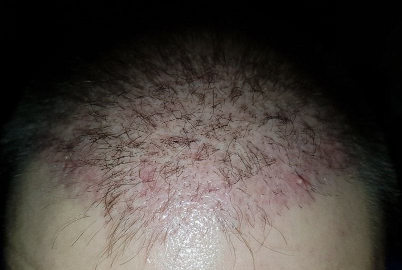 dr Bruno Hair transplant..jpg