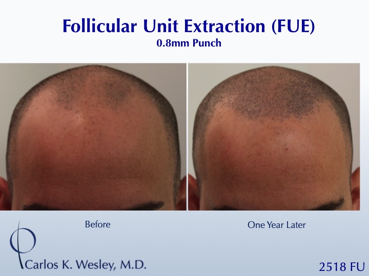 Dr Carlos Wesley Hair Transplant1.jpeg