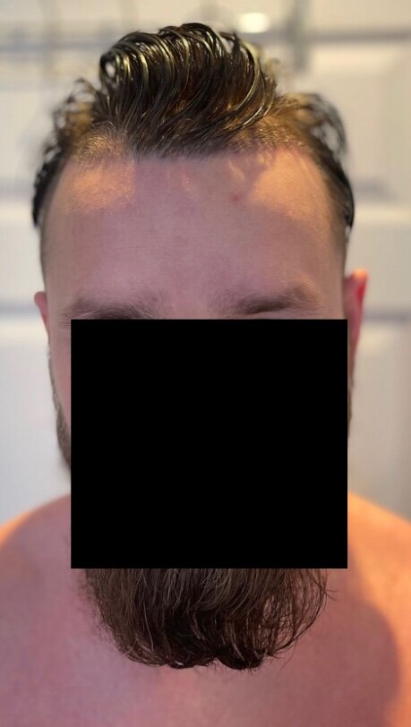 Dr Christian Bisanga FUE Hair Transplant3.jpeg