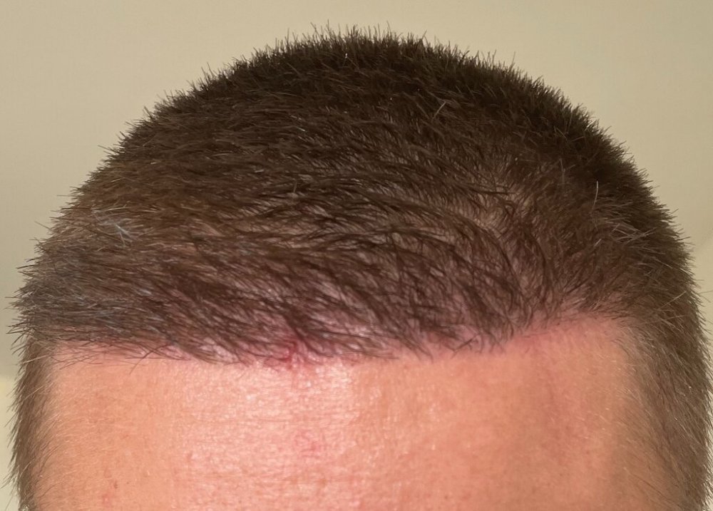 Dr. Cooley hair transplant1.jpeg