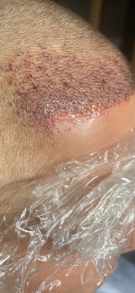 Dr Cooley Hair Transplant10.png