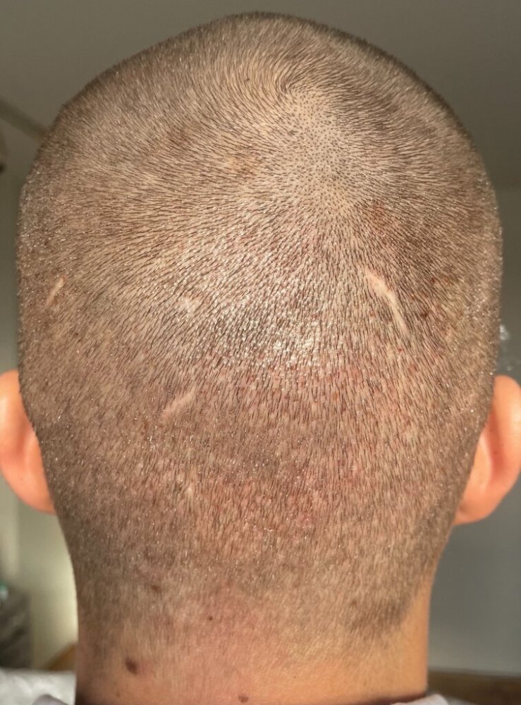 Dr Cooley Hair Transplant11.jpeg