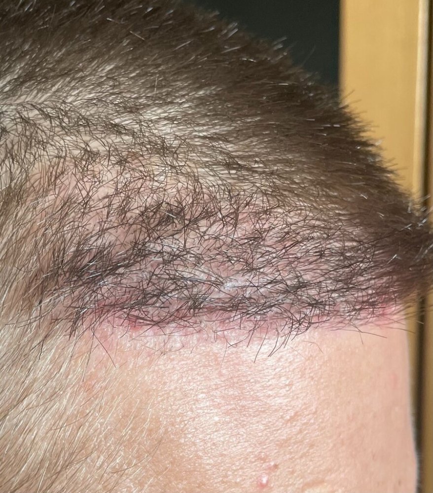 Dr. Cooley hair transplant3.jpeg