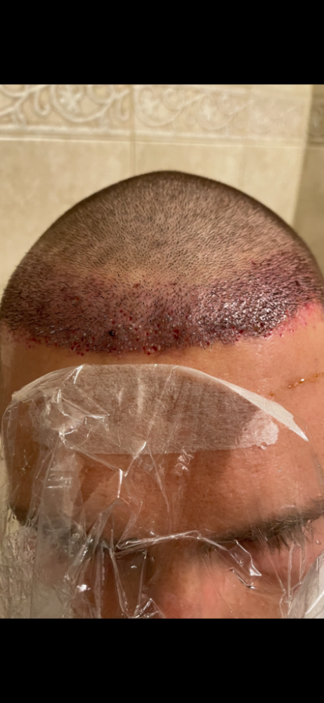 Dr Cooley Hair Transplant3.png