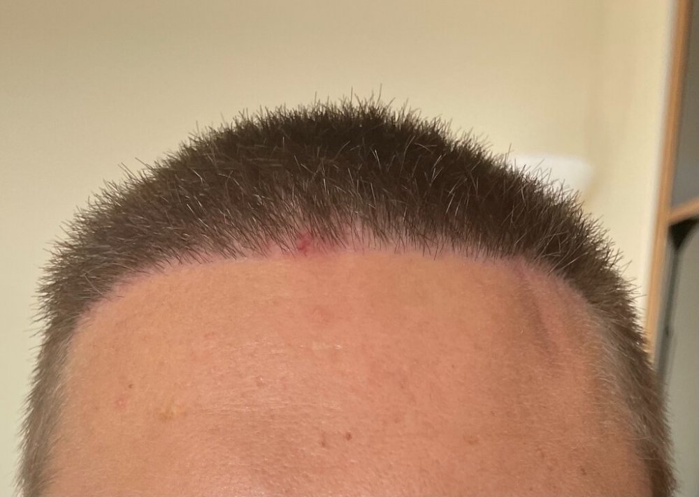 Dr. Cooley hair transplant5.jpeg