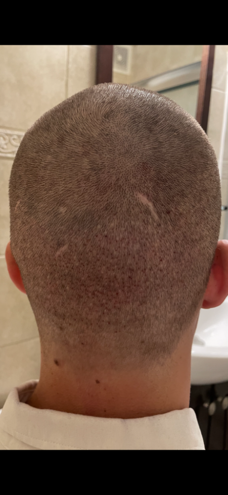 Dr Cooley Hair Transplant5.png