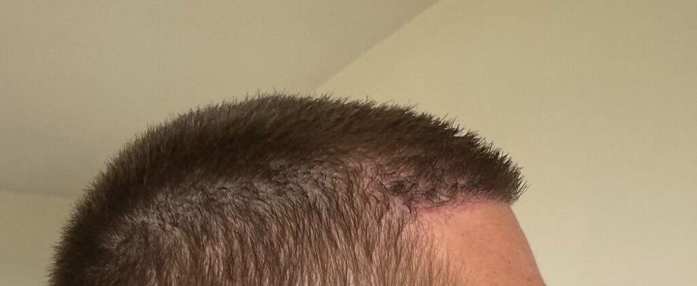 Dr. Cooley hair transplant6.jpeg