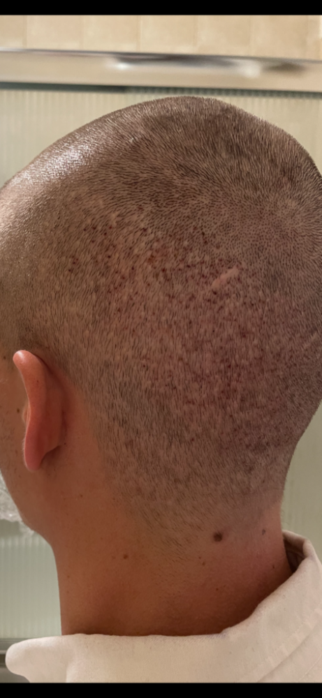 Dr Cooley Hair Transplant6.png