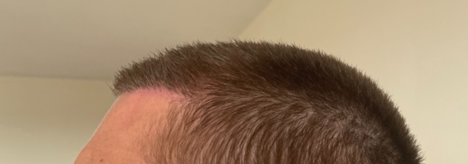 Dr. Cooley hair transplant7.jpeg