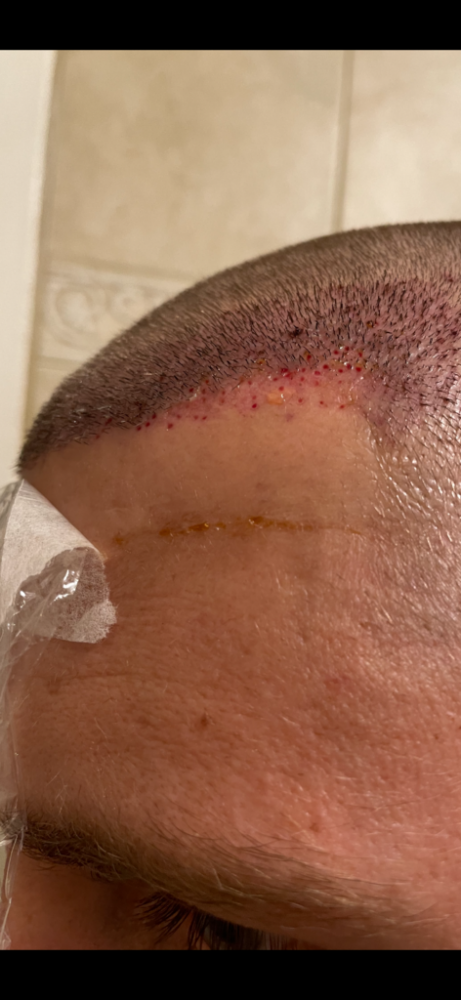 Dr Cooley Hair Transplant7.png