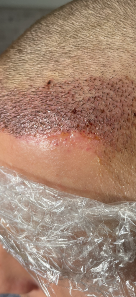 Dr Cooley Hair Transplant9.png