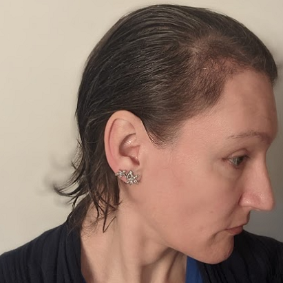 Dr. Edwall Ball, The Maitland Clinic Hair transplant.png