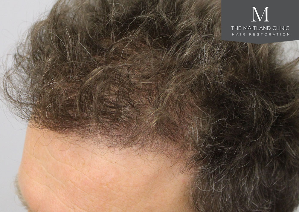 Dr. Edward Ball hair transplant result 10.jpg
