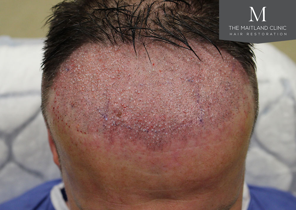Dr. Edward Ball hair transplant result 11.jpg