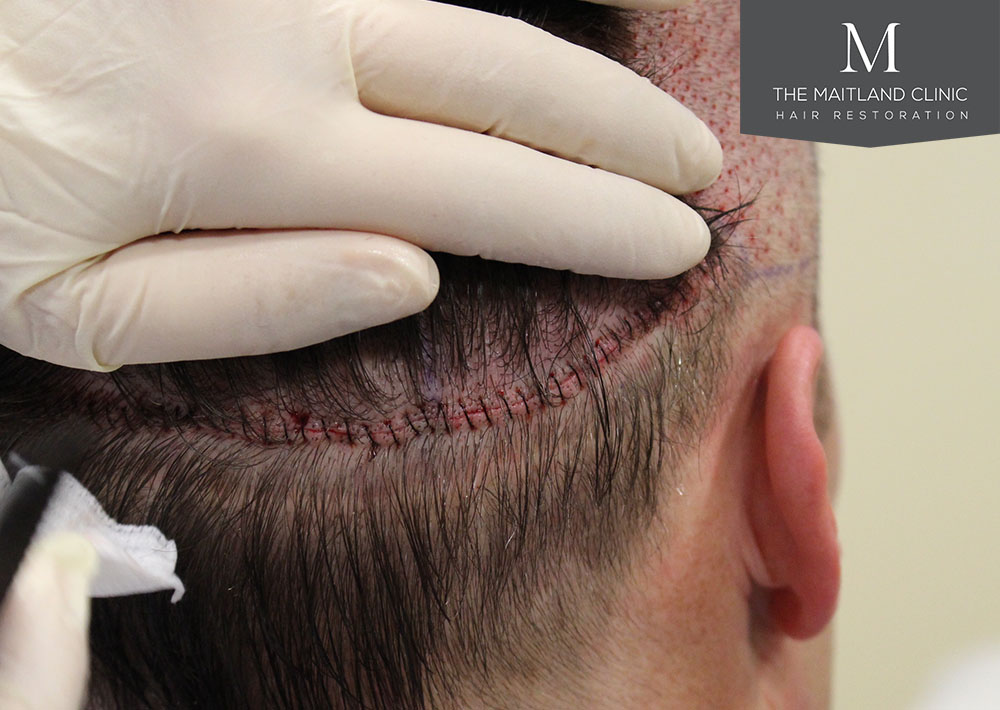Dr. Edward Ball hair transplant result 12.jpg