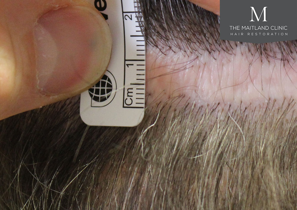 Dr. Edward Ball hair transplant result 13.jpg