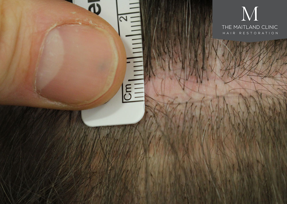 Dr. Edward Ball hair transplant result 14.jpg