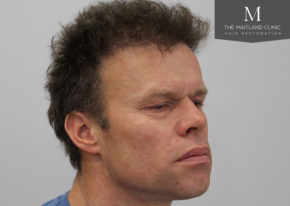 Dr. Edward Ball hair transplant result 2.jpg