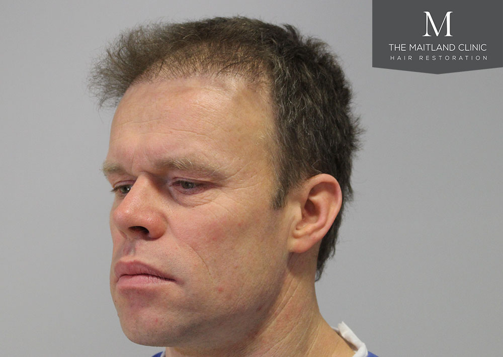 Dr. Edward Ball hair transplant result 3.jpg