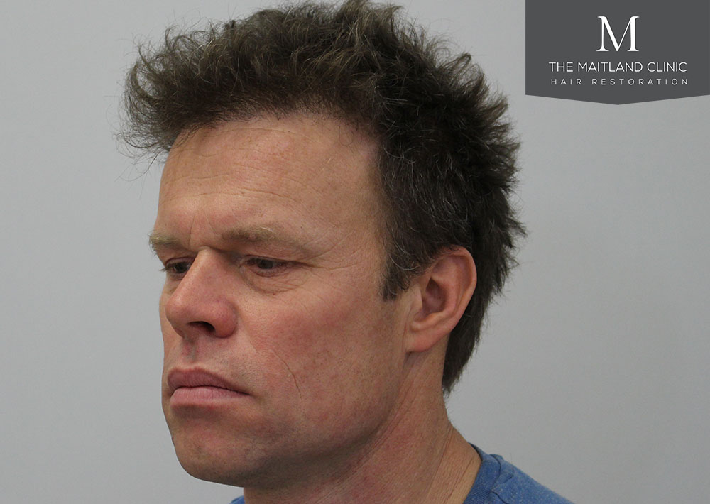 Dr. Edward Ball hair transplant result 4.jpg