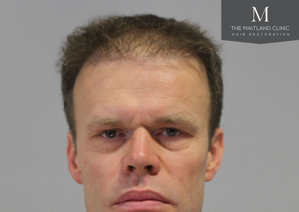 Dr. Edward Ball hair transplant result 5.jpg