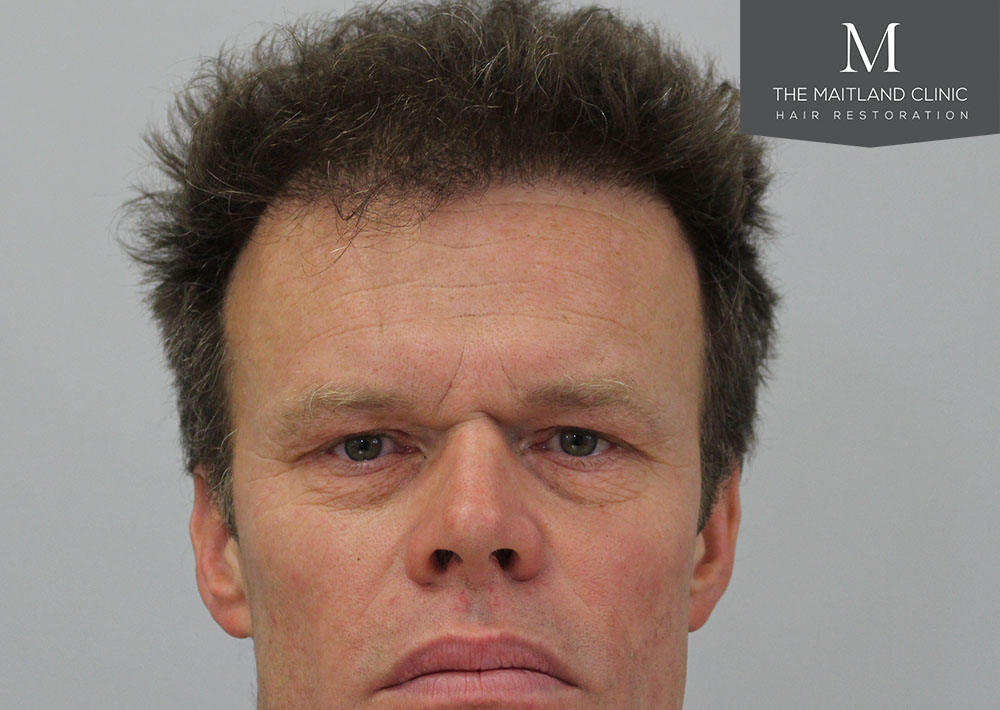 Dr. Edward Ball hair transplant result 6.jpg