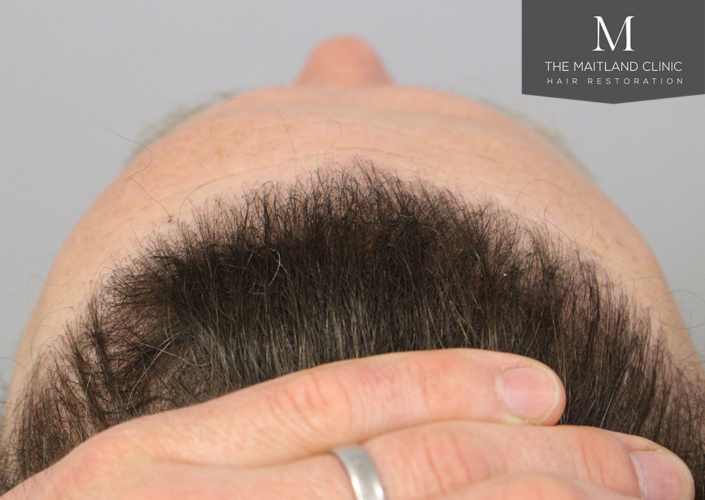 Dr. Edward Ball hair transplant result 8.jpg