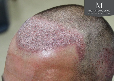 Dr Edward Ball hair transplant review.jpg