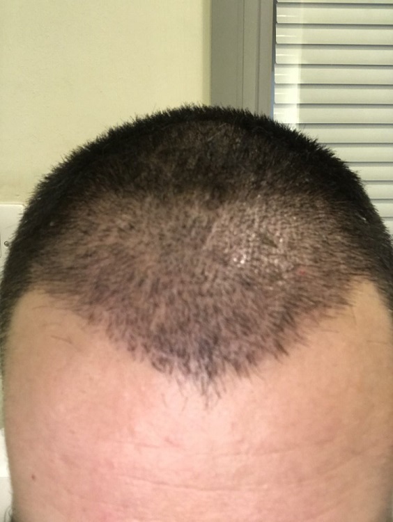 Dr Farjo Hair Transplant..jpeg