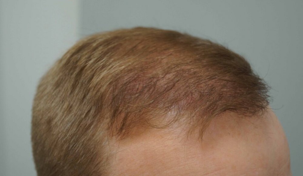 Dr Farjo Hair Transplant10.jpg