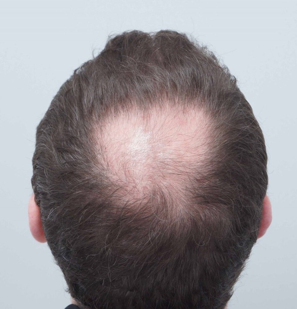 Crown FUE Hair Transplant - Farjo Hair Institute. | Hair loss Forum - Hair  Transplant forums