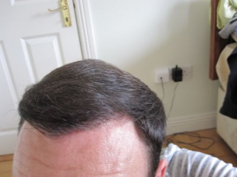 Dr Feller hair transplant result 3.jpg