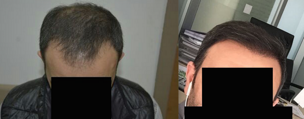DR HAKAN DOGANAY FUE HAIR TRANSPLANT15.png