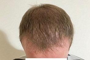 Dr Hakan Doganay hair transplant.jpg